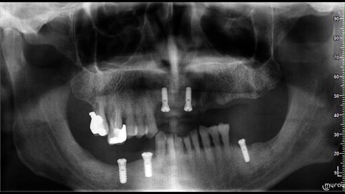 Radiographic verification for Full-Arch Rehabilitation & Deep Bite Correction with 7 Swiss Implants - Scan 1
