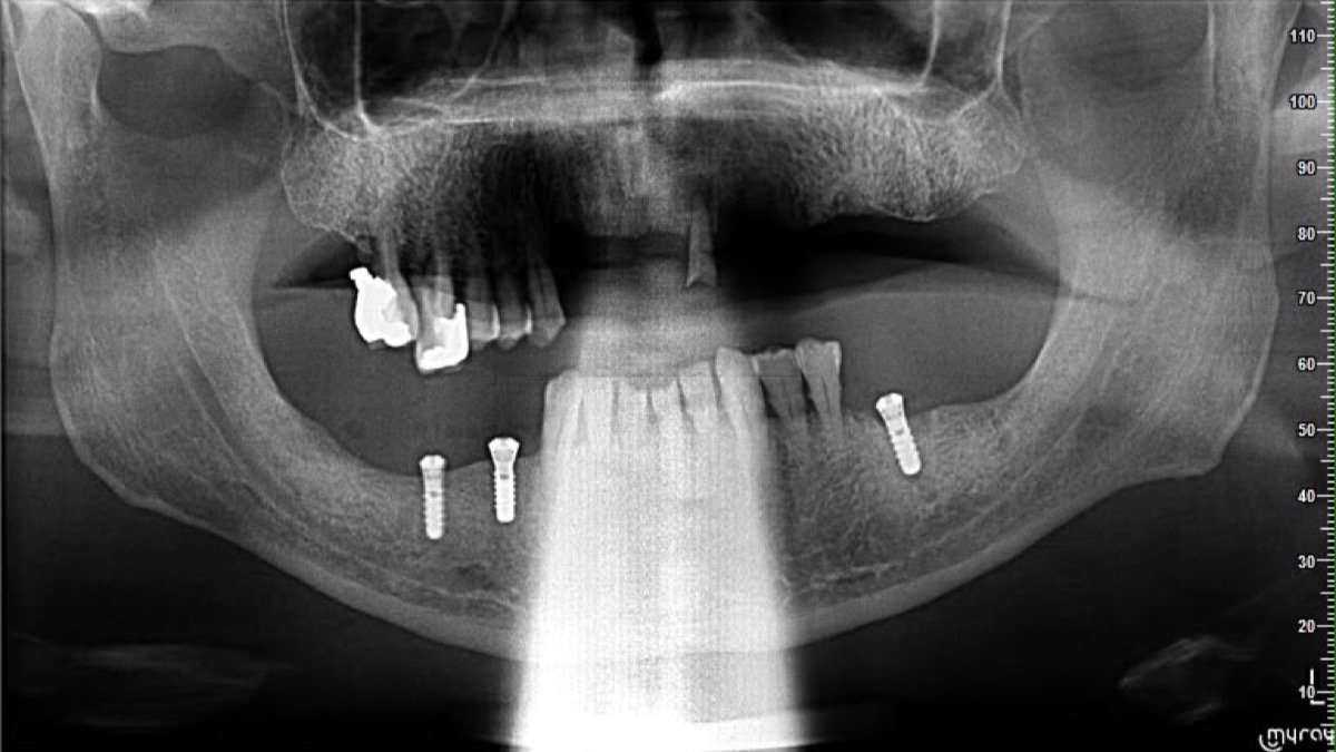 Radiographic verification for Full-Arch Rehabilitation & Deep Bite Correction with 7 Swiss Implants - Scan 2