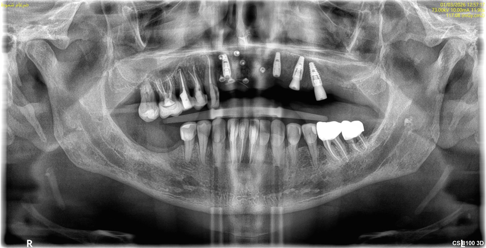 Radiographic verification for Complete Maxillary Arch Fixed Implant Rehabilitation - Scan 1