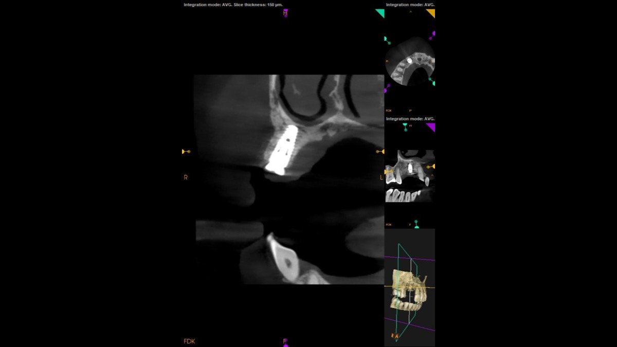 Radiographic verification for Guided Bone Regeneration (GBR) for Severe Alveolar Ridge Resorption - Scan 2