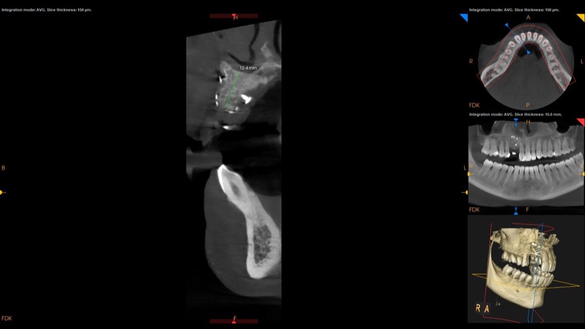 Radiographic verification for Guided Bone Regeneration (GBR) for Severe Alveolar Ridge Resorption - Scan 1
