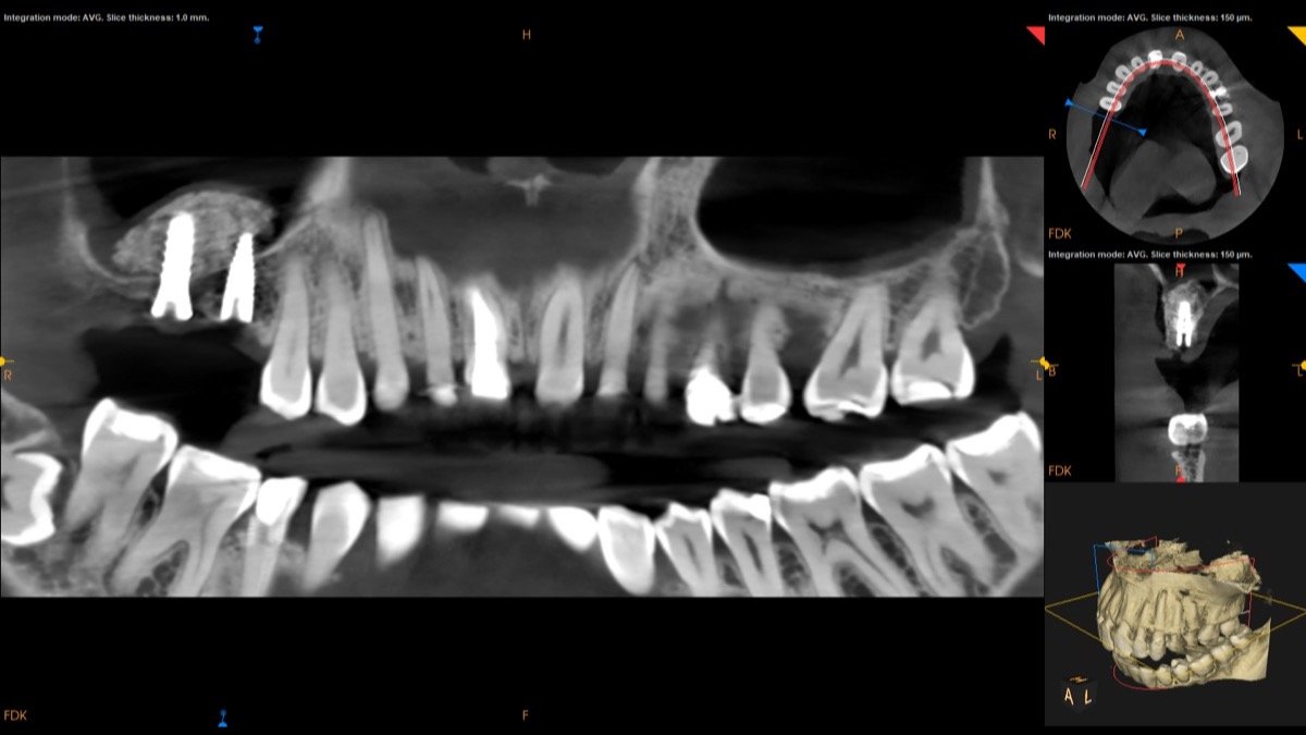 Radiographic verification for Maxillary Sinus Floor Elevation with Simultaneous Implant Placement - Scan 2