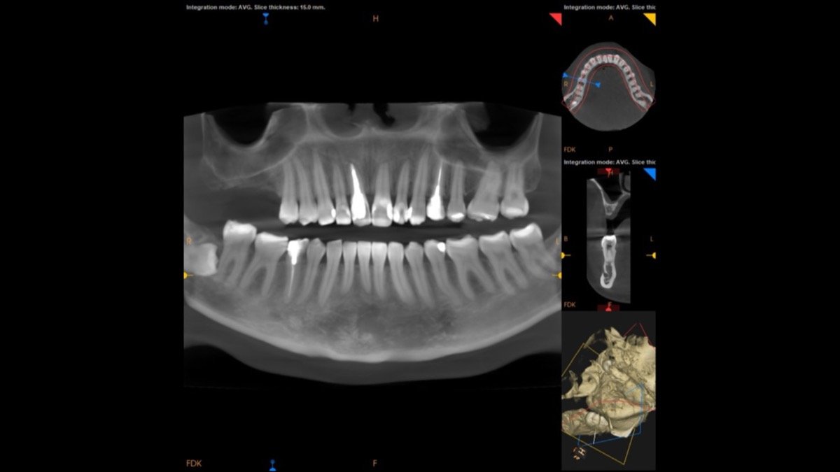 Radiographic verification for Maxillary Sinus Floor Elevation with Simultaneous Implant Placement - Scan 1