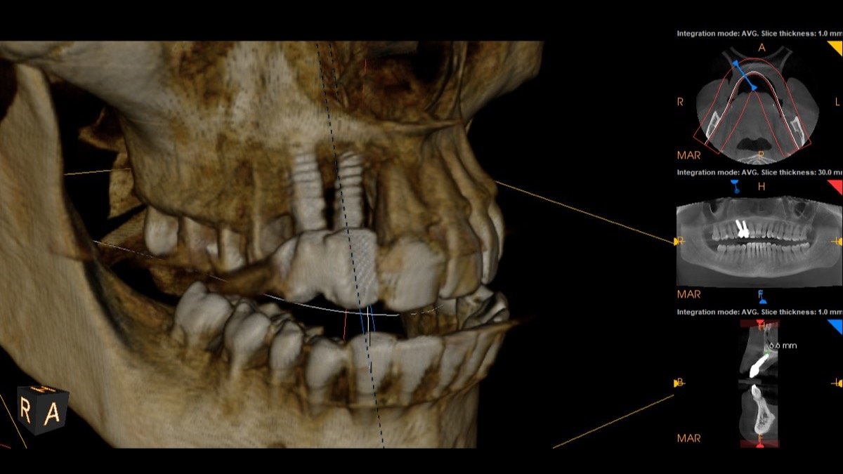 Radiographic verification for Computer-Guided 3D Precision Implant Placement with Surgical Template - Scan 2