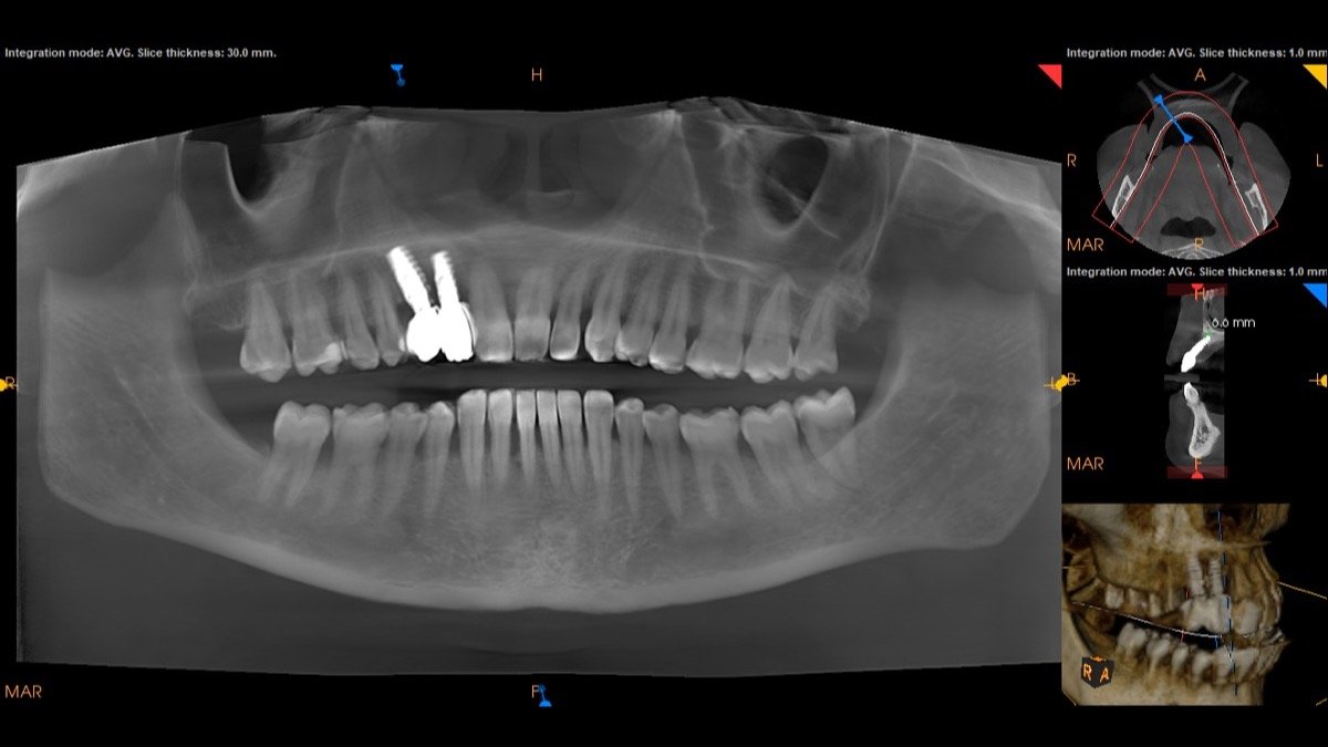 Radiographic verification for Computer-Guided 3D Precision Implant Placement with Surgical Template - Scan 1