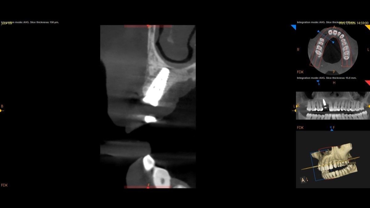 Radiographic verification for Computer-Guided 3D Precision Implant Placement with Surgical Template - Scan 3