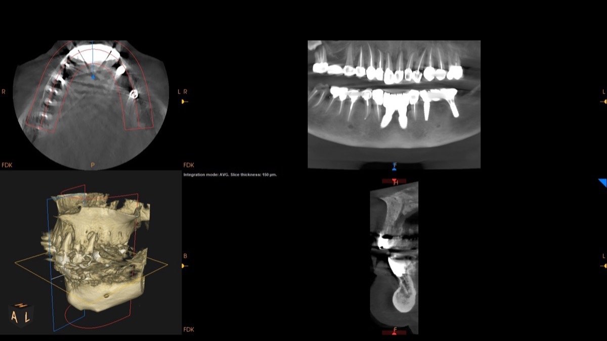Radiographic verification for Anterior Smile Reconstruction & Restorative Implantology - Scan 1