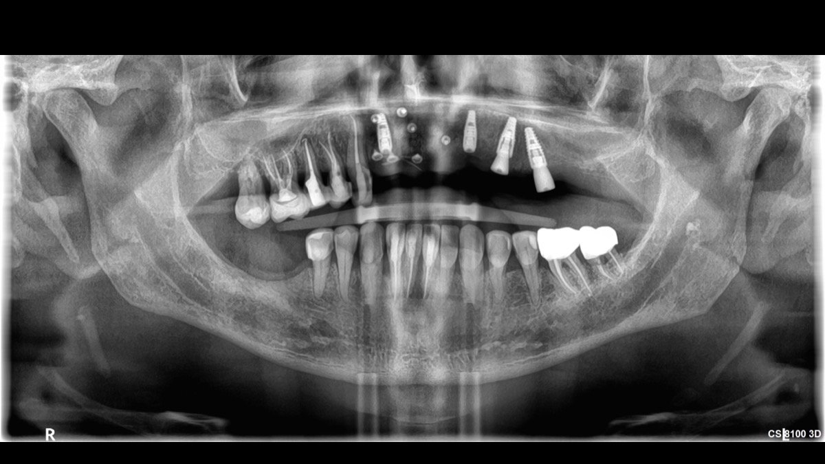 Radiographic verification for Posterior Molar & Premolar Replacement with Swiss Titanium Implants - Scan 1